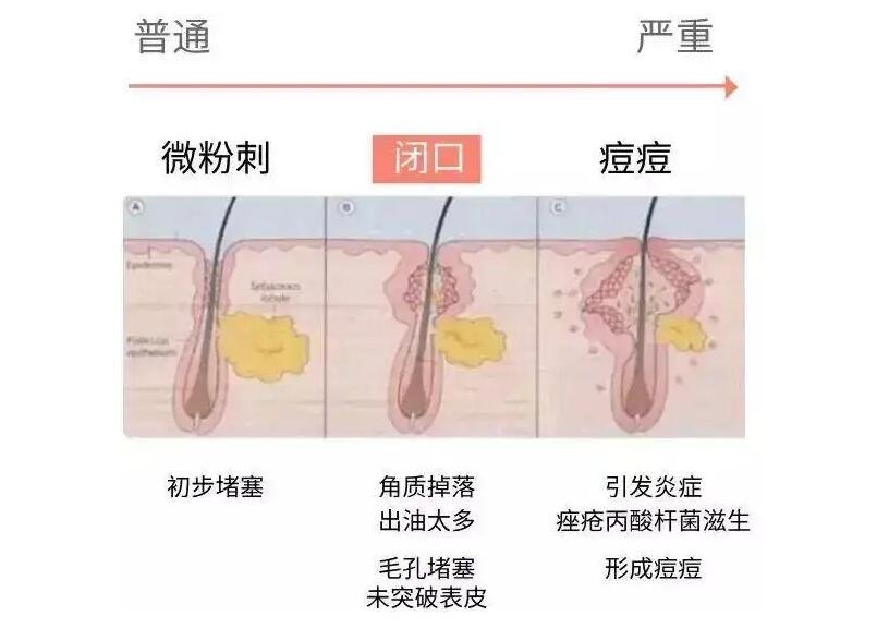 閉口是怎么產(chǎn)生的？閉口應(yīng)該怎么去除？